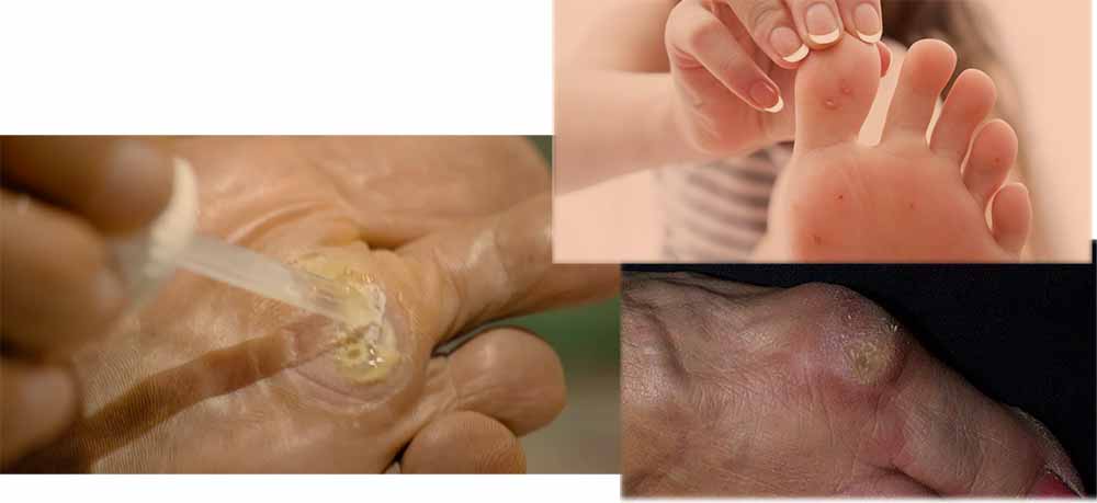 otiščanci-kurje-oko